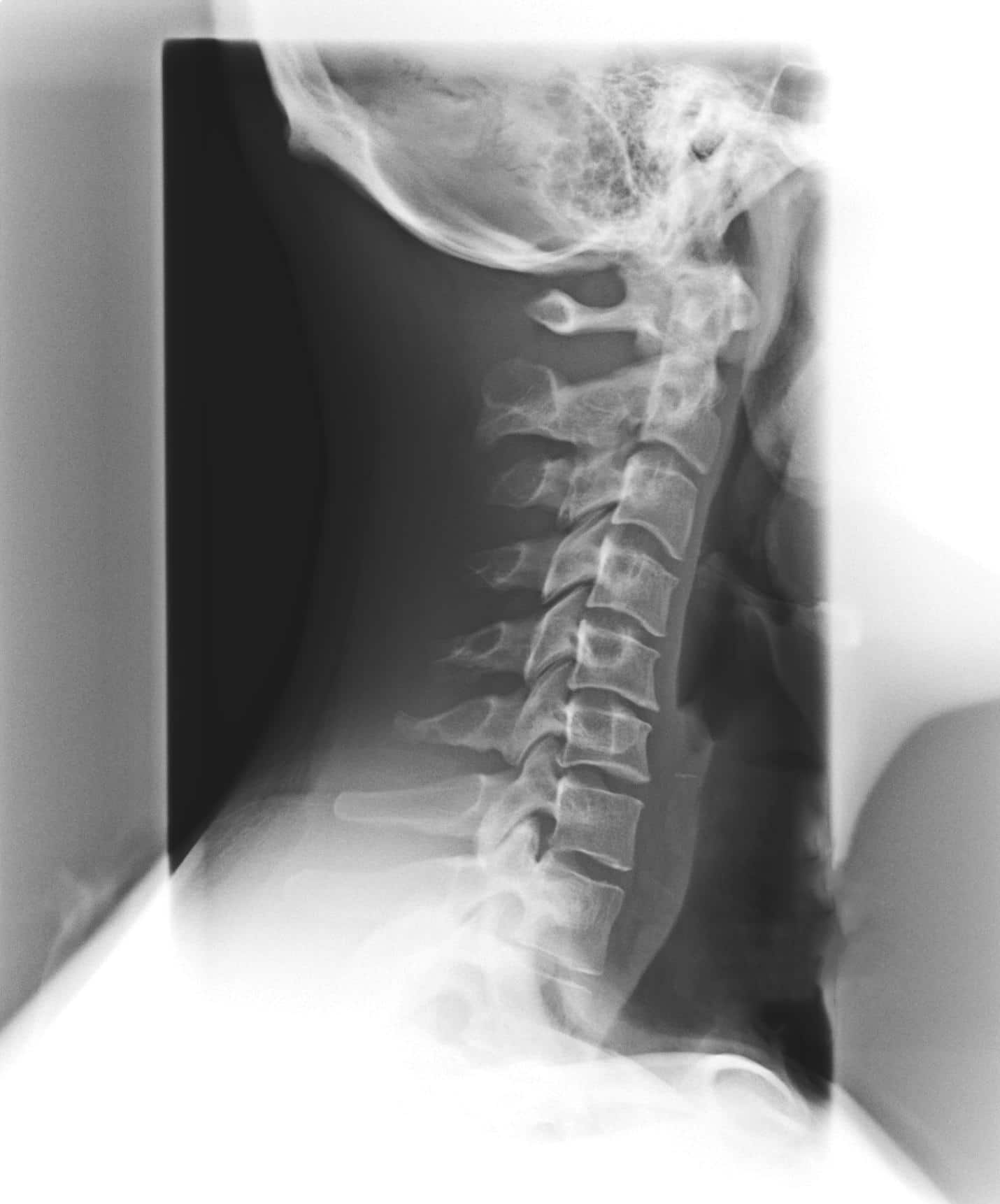 Spinal Degeneration Phase II