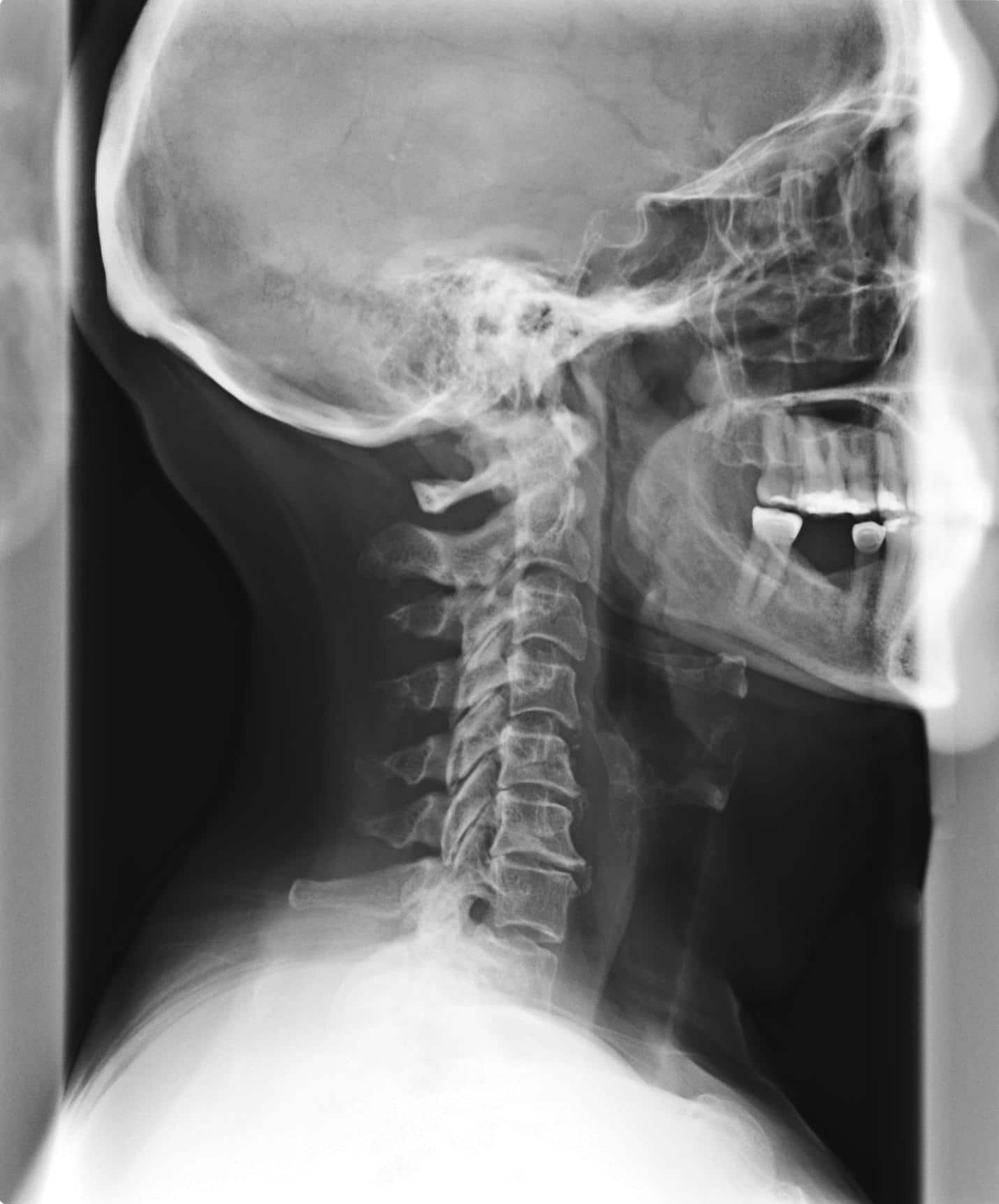 Spinal Degeneration Phase III